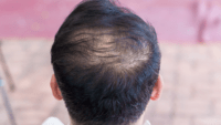 Understanding the Causes of Thinning Hair and What You Can Do About It